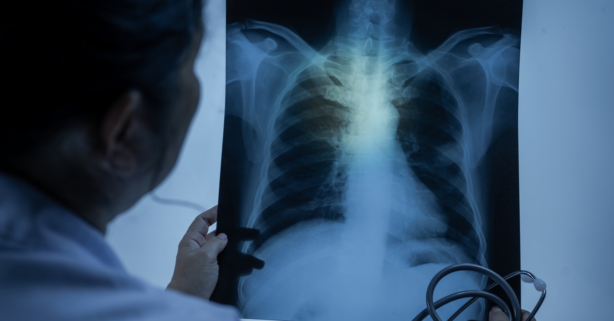 Dünya Sağlık Örgütü: 2023’te 8.2 milyon kişiye tüberküloz teşhisi konuldu