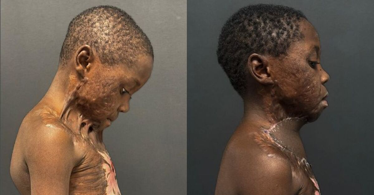 Oyun oynarken yanan Kamerunlu çocuk, 7 saatlik operasyonla sağlığına kavuştu