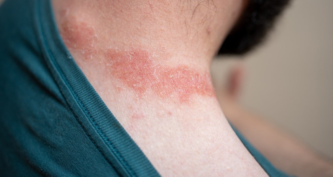 Yıllarca hastalığına çözüm bulamadı: Tek bir yöntemle kurtuldu!